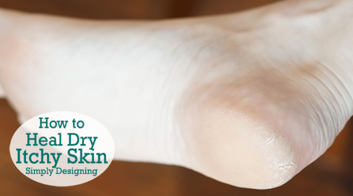 How to Heal Dry Itchy Skin Featured Image | How to Heal Dry Itchy Skin | 3 | Homemade Spa Treatments