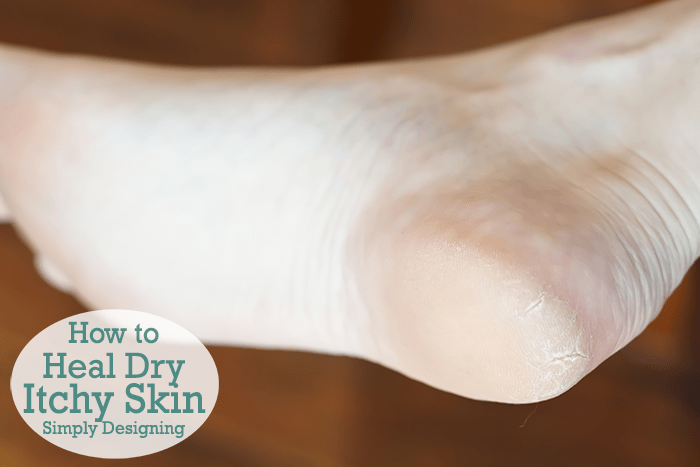 How to Heal Dry Itchy Skin