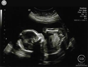 20 week ultrasound 01 Pregnancy #6 : Week 19-20 Update 16
