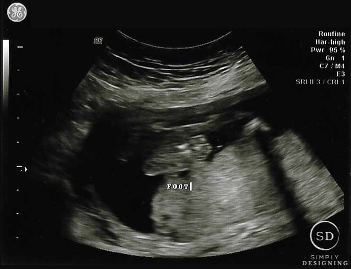 20 week ultrasound