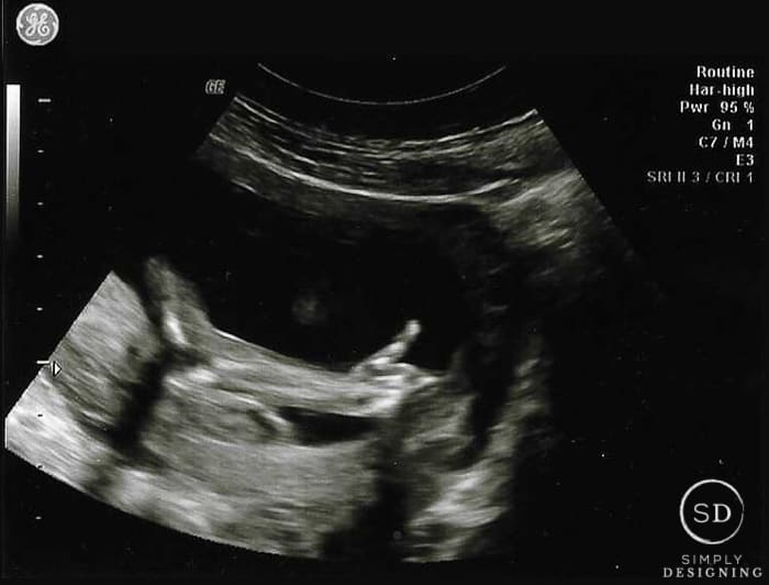 20 week ultrasound